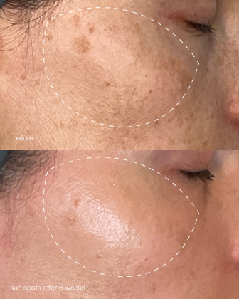 Результат використання Melanopro Peel System: до і після