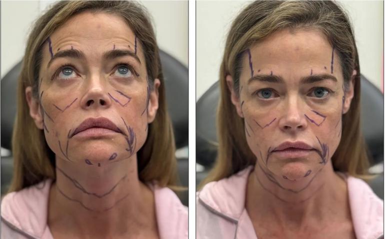 Деніз Річардс зробила пластику обличчя