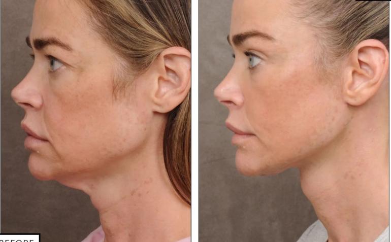 Деніз Річардс зробила пластику обличчя