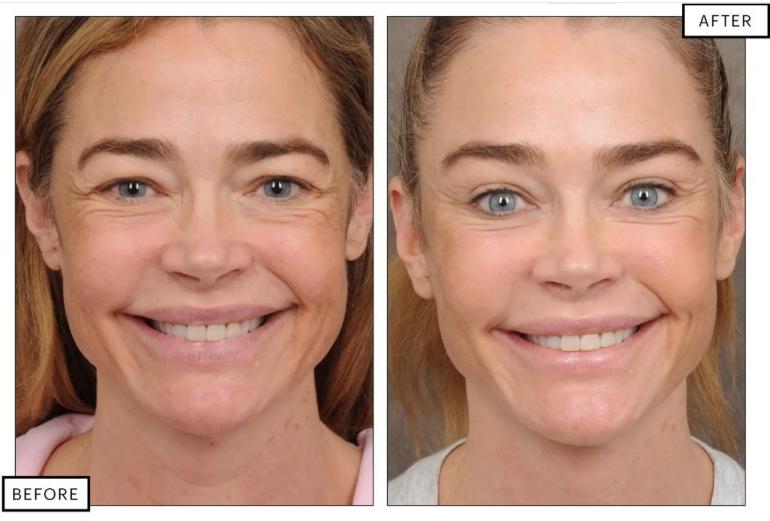 Деніз Річардс зробила пластику обличчя