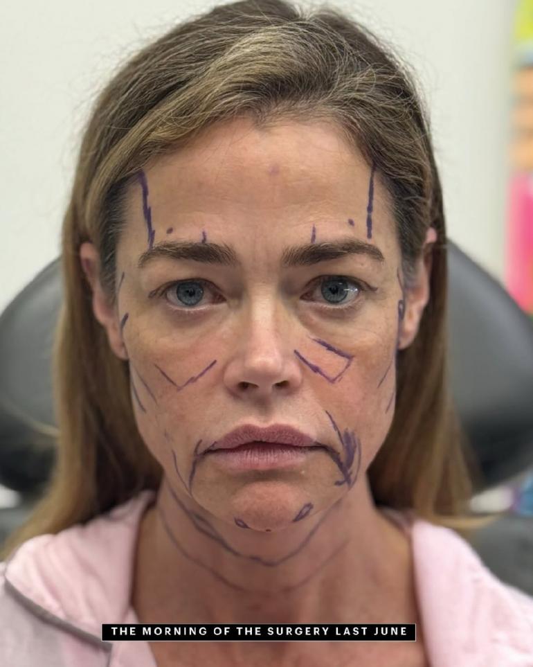 Деніз Річардс зробила пластику обличчя