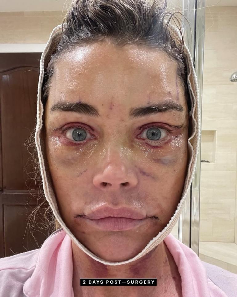 Деніз Річардс показала обличчя одразу після пластичної операції